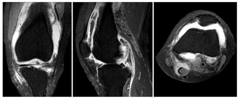 Mri Of The Knee In Adult Onset Stills Disease T2 Weighted Images