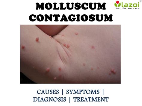 Molluscum Contagiosum Causes Symptoms And Treatment By Lazoithelife