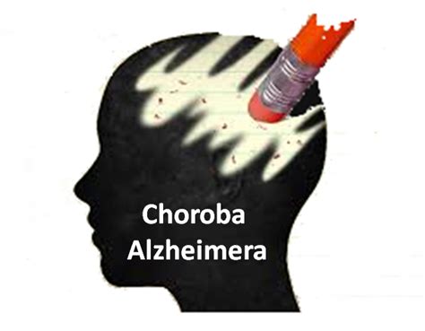 Choroba Alzheimera Co To Jest Radio Sovo