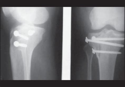 Orif Medial Tibial Plateau Fracture