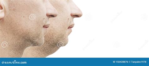 Male Double Chin Before And After Treatment Lifting Stock Photo Image