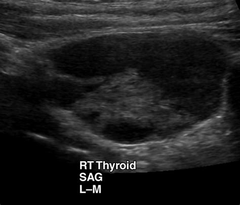 Cystic Parathyroid Adenoma Sonographic Features And Correlation With