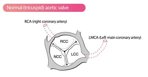Aortic Stenosis Echocardiography Diagnosis Grading Causes Management