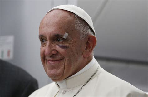 Pope Francis Black Eye Tells Us A Lot About The Church Today America