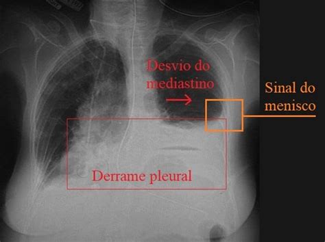 Derrame Pleural Pulmonar Causas Sintomas E Tratamento