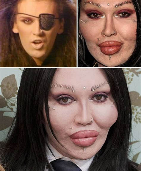 Cosmetic Surgery Disasters Pete Burns Plastic Surgery Stars