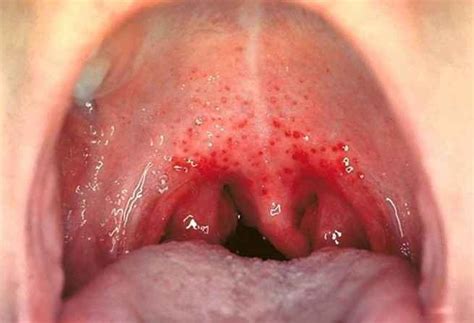 Bump On The Roof Of Mouth Pictures Causes And Treatment