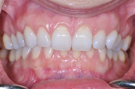 Gingival Gum Grafting Dental Implants And Periodontics Of Ct