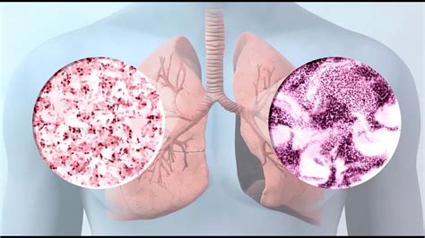 Lung Cancer 9 Common Treatment Options YouTube