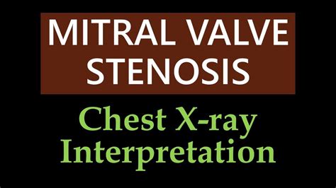 Mitral Valve Stenosis Chest X Ray Interpretation Youtube