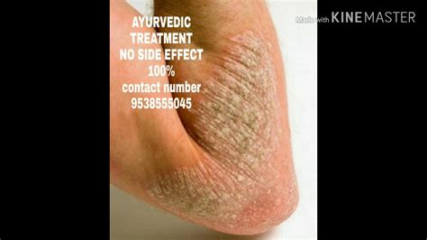 Fungal Skin Infection Ayurvedic Treatment Youtube