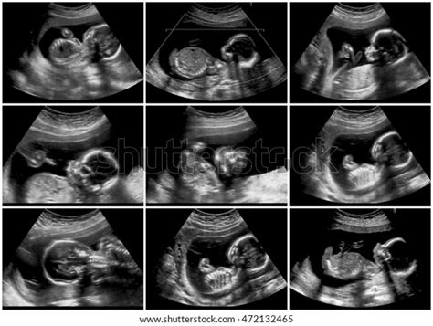 Series 9 Ultrasound 20 Weeks Fetus Stock Photo Edit Now 472132465