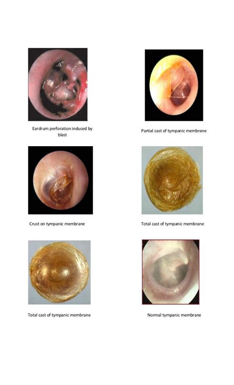 Otitis Externa Tympanic Membrane