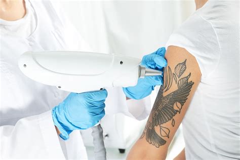 Tatueringsborttagning Med Laser Let’s Deal