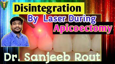 Disinfection By Laser During Apicoectomy Dr Sanjeeb Rout Balaji