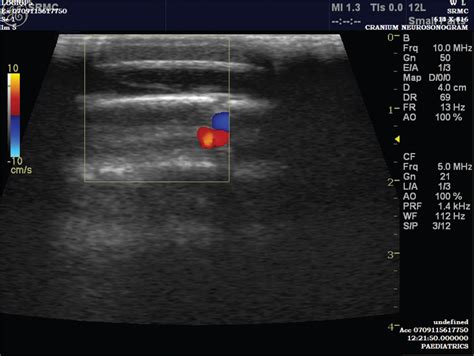 Subaponeurotic Fluid Collection An Unusual Cause Of Scalp Swelling In