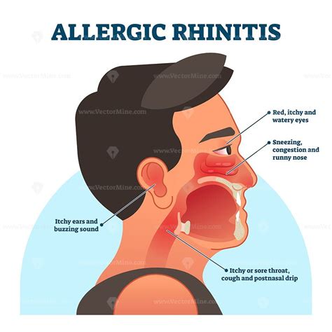 Allergic Rhinitis Medical Diagram Vector Illustration Labeled