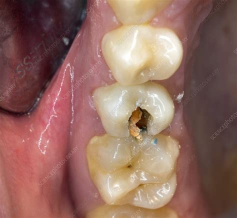 Dental Caries Stock Image C0291844 Science Photo Library