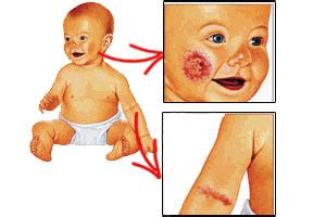 Dermatite Atopica Nei Bambini E Neonati Mammamedico It