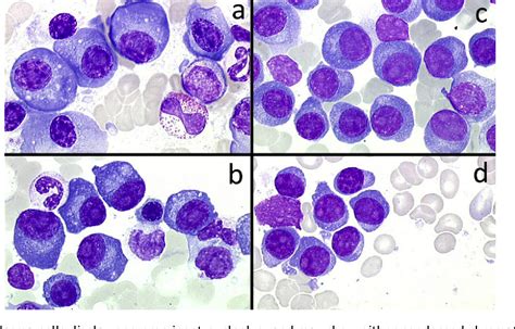 Figure 5 From Plasma Cell Morphology In Multiple Myeloma