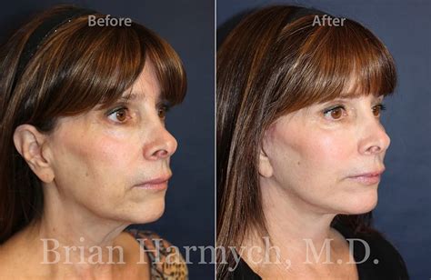 Facial Plastic Surgeon About Dr Harmych Cleveland Oh