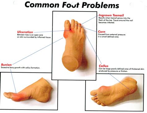 Common Foot Problems Medicalfootcarecenter 211redmondroadromega