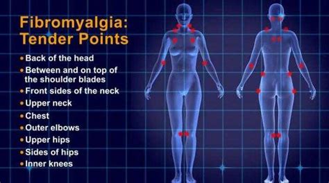 Confused About Fibromyalgia Trigger Points And Fibromyalgia Tender Points