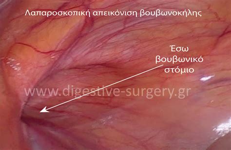 Digestive Surgery Χειρουργική πεπτικού Laparoscopic Hernia Repair
