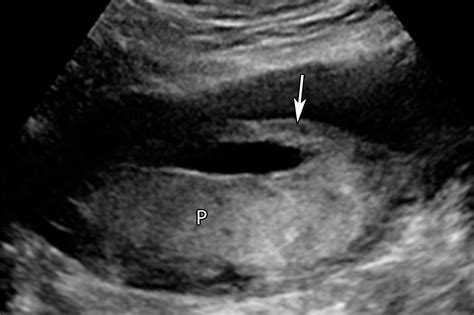 Placental Imaging Normal Appearance With Review Of Pathologic Findings