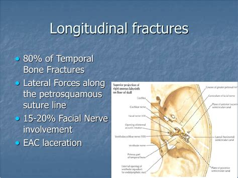Ppt Fracture Of Temporal Bone Powerpoint Presentation Free Download