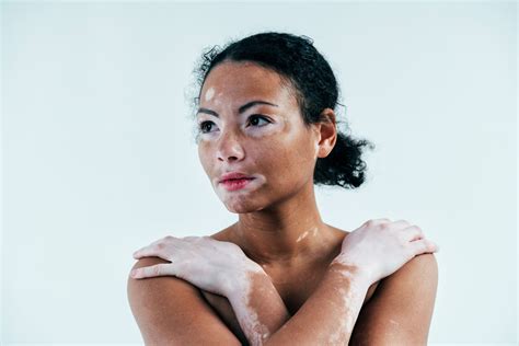 Vitiligo é Genético Confira Mitos E Verdades Sobre O Tema Genera