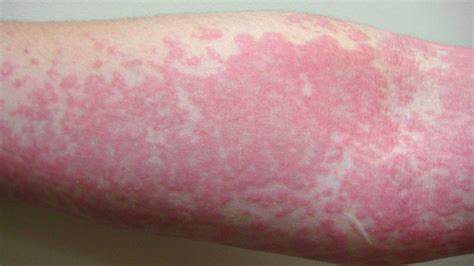 Hives Vs Rash Common Rashes Of The Skin Part 4 Urticaria Florida Skin