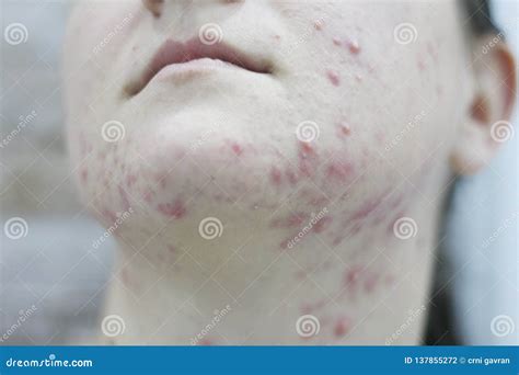 Allergy Conceptyoung Girl With Problematic Pimple On The Face Image