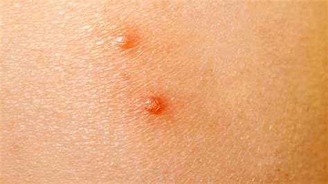 Molluscum Contagiosum Infection Bumps Rash On Skin Of