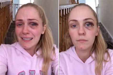 Domestically Abused Woman With Black Eye Posts Video After Leaving Aggressive Partner Daily Star