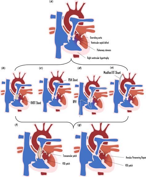 Tetralogy Of Fallot Stent Palliation Or Neonatal Repair Cardiology