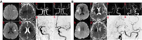 Frontiers Intracranial Atherosclerotic Disease Related Acute Middle Cerebral Artery Occlusion