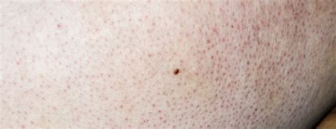 Blackheads On Back Of Thighs