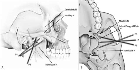 Technique Of Mandibular And Maxillary Nerve Blocks Lateral A And