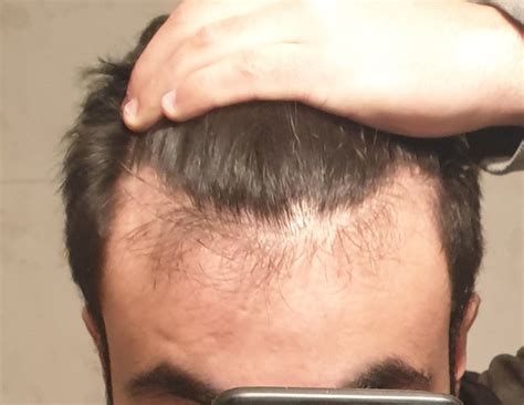 Early Signs Of Male Pattern Baldness Help Hairlosstalk Forums