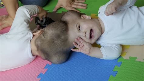 Conjoined Twins Doctors Separate Brothers Joined At The Head Channel