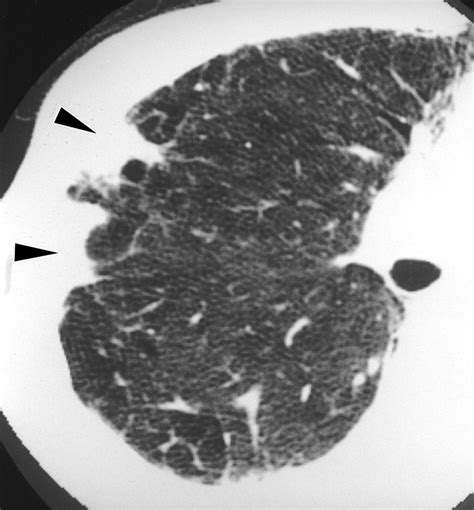High Resolution Ct Of Asbestosis And Idiopathic Pulmonary Fibrosis Ajr