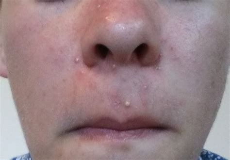 Daily Whitehead Breakout Under Nose General Acne Discussion Acne