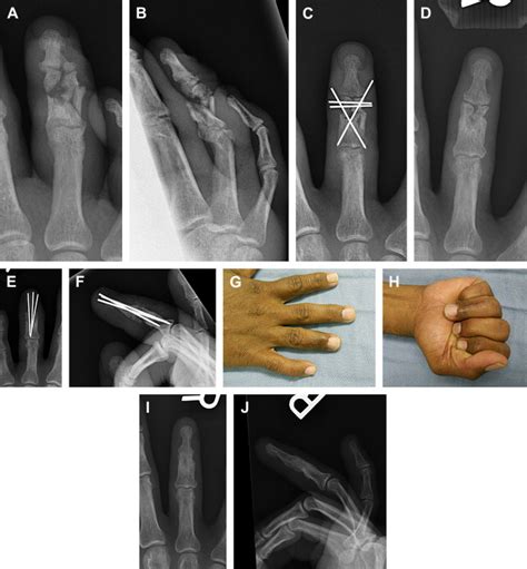 Treatment Of Nonunion And Malunion Following Hand Fractures Plastic