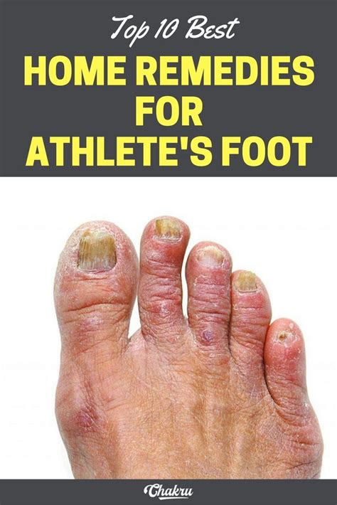 Best Home Remedies For Athletes Foot And How To Prevent It Athletes Foot Remedies Foot
