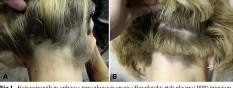 successful treatment of corticosteroid resistant ophiasis type alopecia areata aa with
