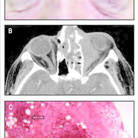 A 47 Year Old Man With Right Lacrimal Orbital Pseudotumor A The