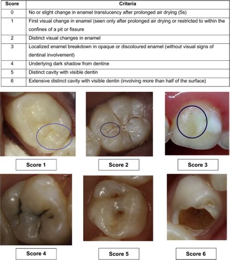 Detection Activity Assessment And Diagnosis Of Dental Caries Lesions