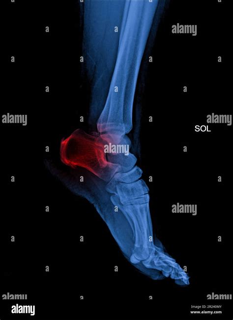 Arthritis At Ankle Joint Gout Rheumatoid Arthritis Stock Photo Alamy