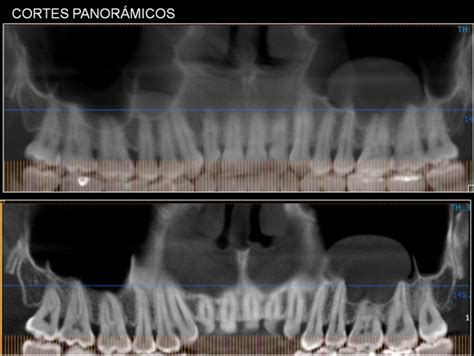 Caso 403 QUISTE DE RETENCIÓN MUCOSO CDI